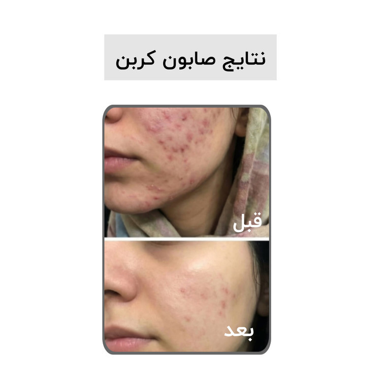 صابون کربن سیاه (کربن اکتیو) بیز ضدجوش، ضد لک و لایه بردار پوست