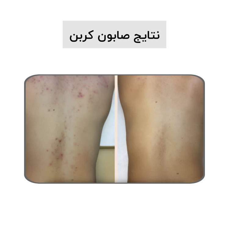 صابون کربن سیاه (کربن اکتیو) بیز ضدجوش، ضد لک و لایه بردار پوست