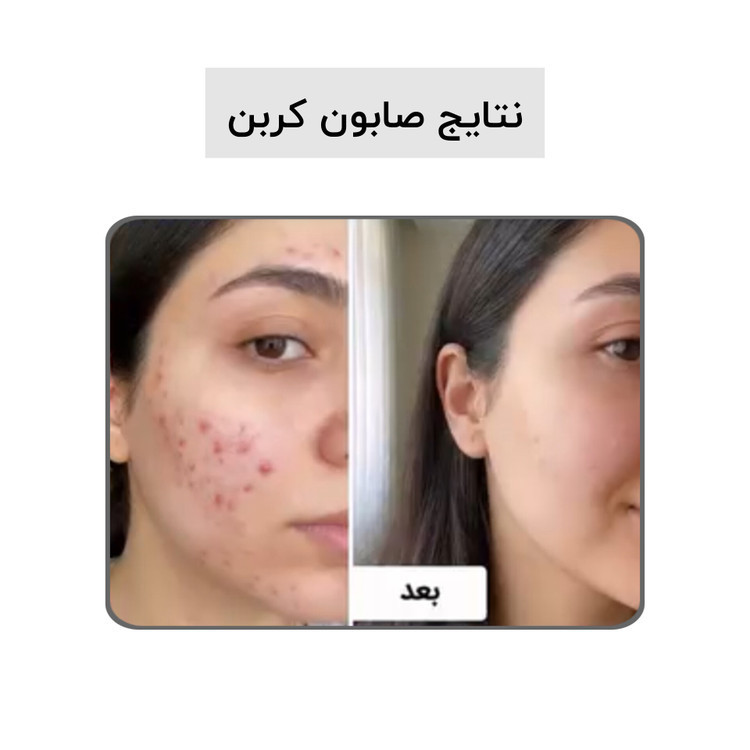 صابون کربن سیاه (کربن اکتیو) بیز ضدجوش، ضد لک و لایه بردار پوست